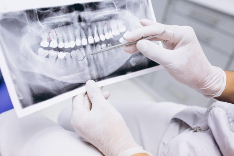 x-ray-teeth