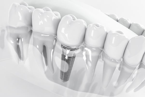 view-from-false-tooth-implant-fixed-jawbone-3d-3d-illustration