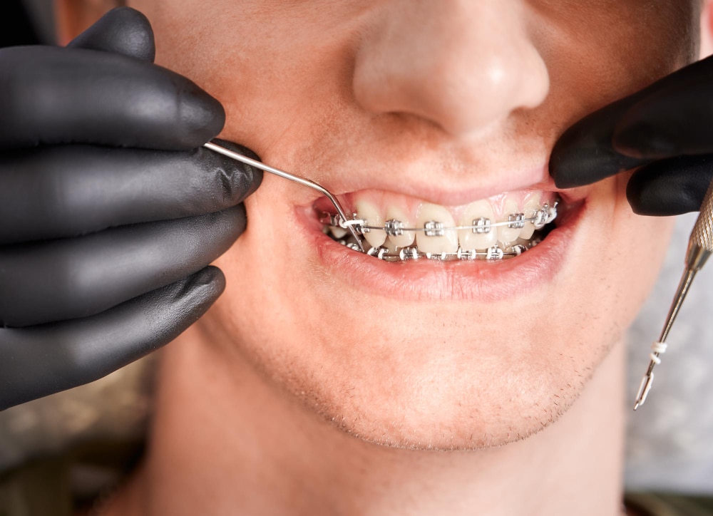 orthodontist-placing-rubber-bands-male-patient-braces (1)