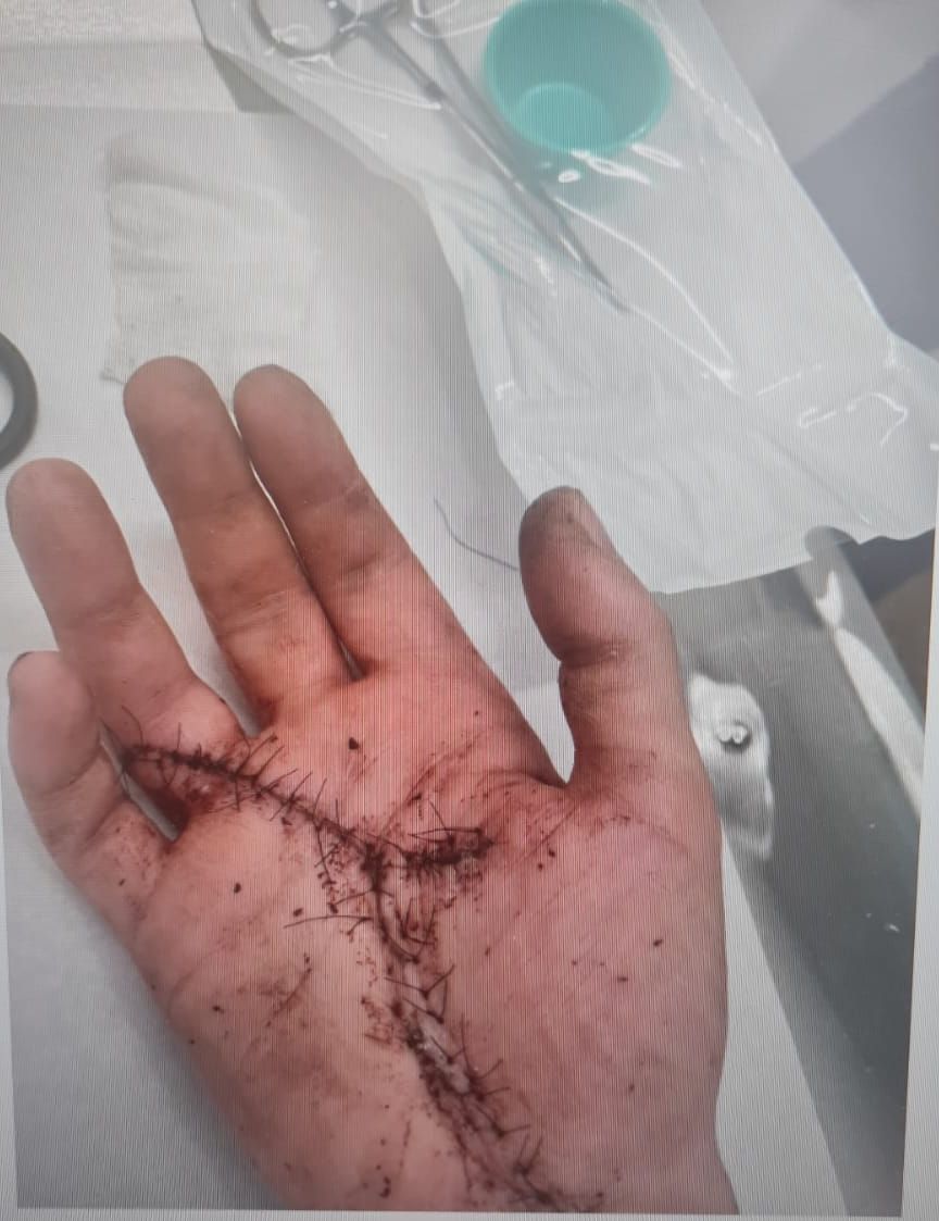 דקירה פציעה כף יד צילום דוברות משטרת ישראל